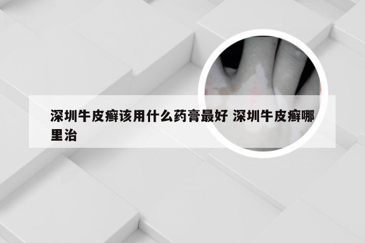 深圳牛皮癣该用什么药膏最好 深圳牛皮癣哪里治