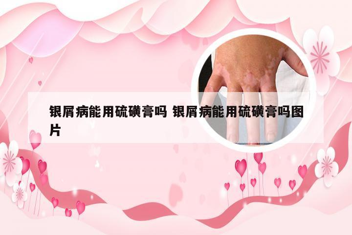 银屑病能用硫磺膏吗 银屑病能用硫磺膏吗图片
