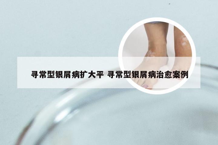 寻常型银屑病扩大平 寻常型银屑病治愈案例