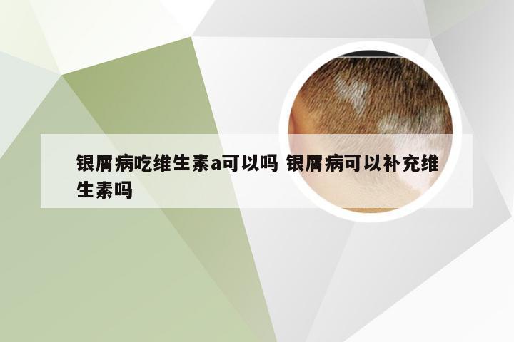 银屑病吃维生素a可以吗 银屑病可以补充维生素吗