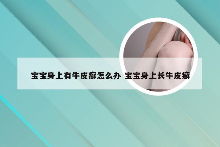 宝宝身上有牛皮癣怎么办 宝宝身上长牛皮癣