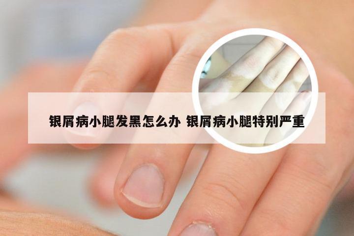 银屑病小腿发黑怎么办 银屑病小腿特别严重