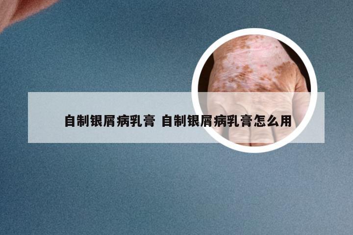 自制银屑病乳膏 自制银屑病乳膏怎么用