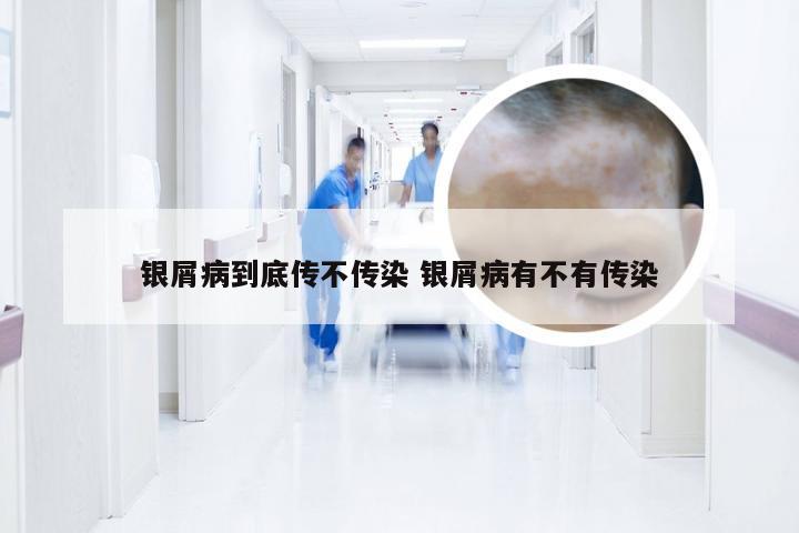 银屑病到底传不传染 银屑病有不有传染
