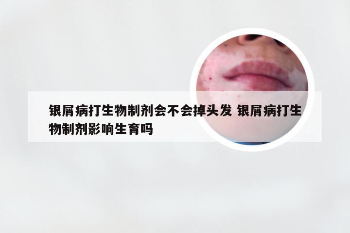 银屑病打生物制剂会不会掉头发 银屑病打生物制剂影响生育吗