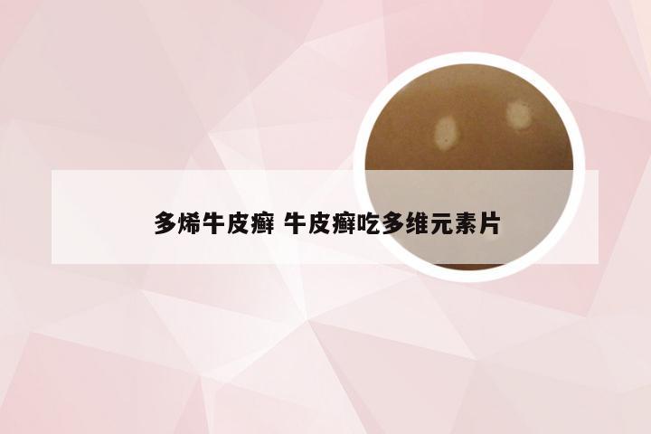 多烯牛皮癣 牛皮癣吃多维元素片