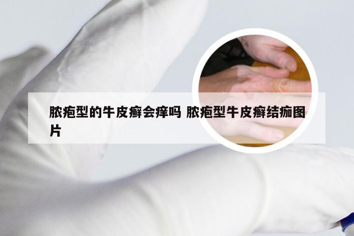 脓疱型的牛皮癣会痒吗 脓疱型牛皮癣结痂图片