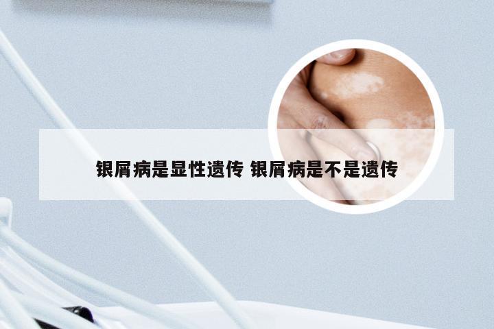 银屑病是显性遗传 银屑病是不是遗传