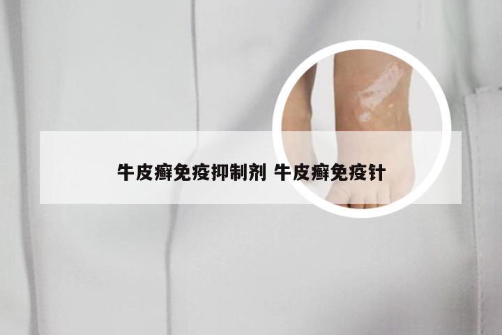 牛皮癣免疫抑制剂 牛皮癣免疫针