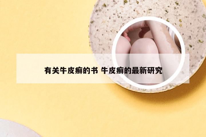 有关牛皮癣的书 牛皮癣的最新研究