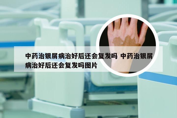 中药治银屑病治好后还会复发吗 中药治银屑病治好后还会复发吗图片