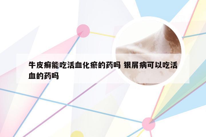 牛皮癣能吃活血化瘀的药吗 银屑病可以吃活血的药吗