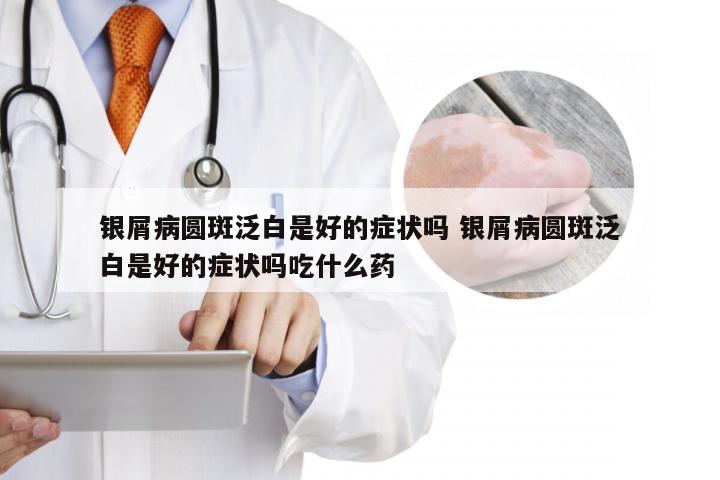 银屑病圆斑泛白是好的症状吗 银屑病圆斑泛白是好的症状吗吃什么药