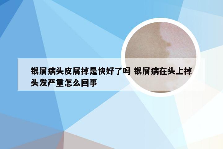 银屑病头皮屑掉是快好了吗 银屑病在头上掉头发严重怎么回事