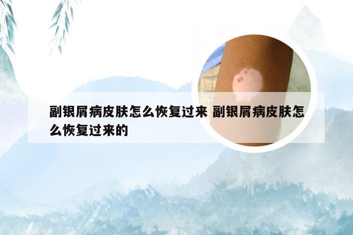 副银屑病皮肤怎么恢复过来 副银屑病皮肤怎么恢复过来的