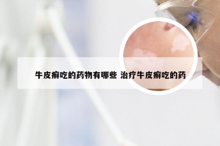 牛皮癣吃的药物有哪些 治疗牛皮癣吃的药