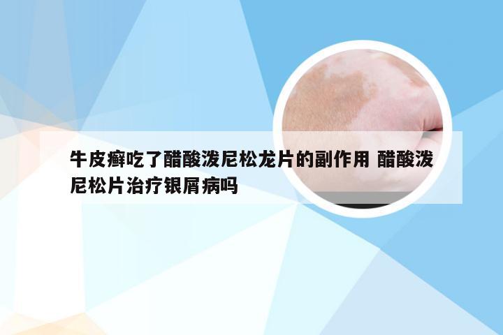 牛皮癣吃了醋酸泼尼松龙片的副作用 醋酸泼尼松片治疗银屑病吗