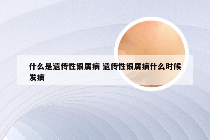 什么是遗传性银屑病 遗传性银屑病什么时候发病