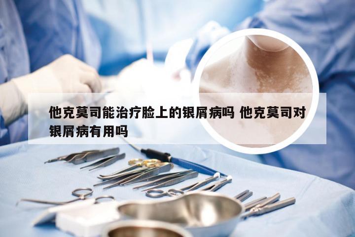 他克莫司能治疗脸上的银屑病吗 他克莫司对银屑病有用吗