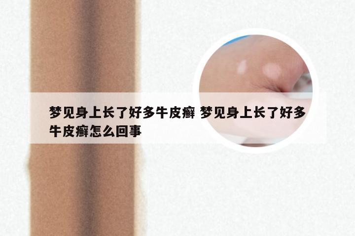 梦见身上长了好多牛皮癣 梦见身上长了好多牛皮癣怎么回事