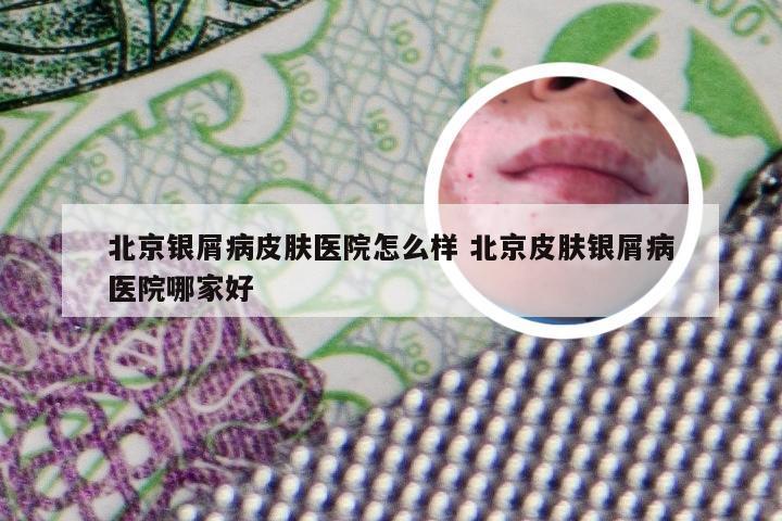 北京银屑病皮肤医院怎么样 北京皮肤银屑病医院哪家好