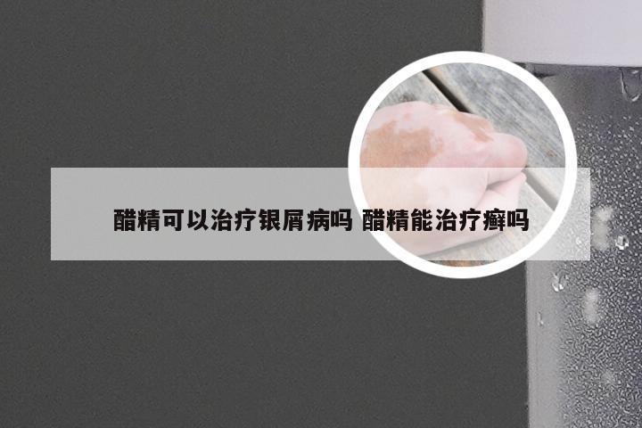 醋精可以治疗银屑病吗 醋精能治疗癣吗