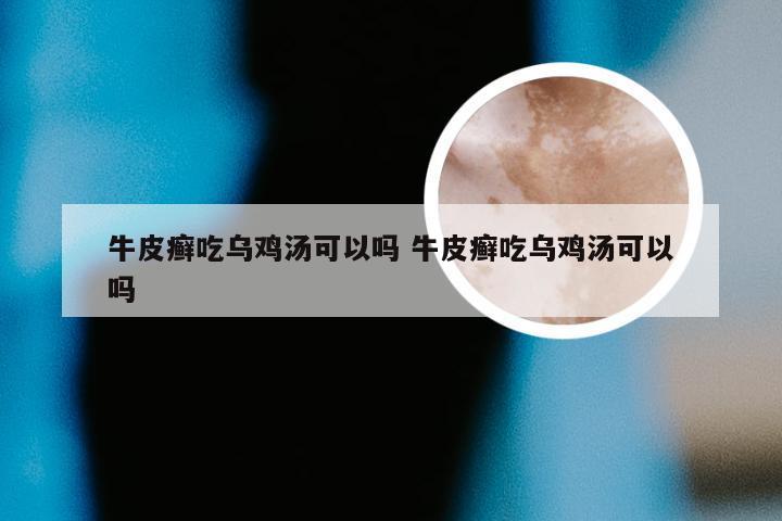 牛皮癣吃乌鸡汤可以吗 牛皮癣吃乌鸡汤可以吗
