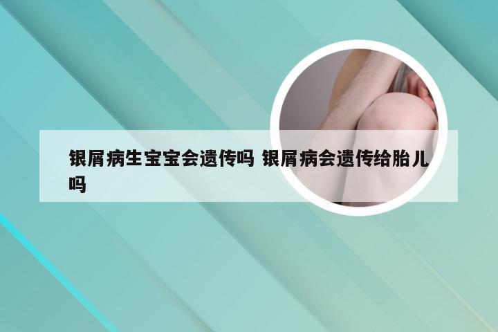 银屑病生宝宝会遗传吗 银屑病会遗传给胎儿吗