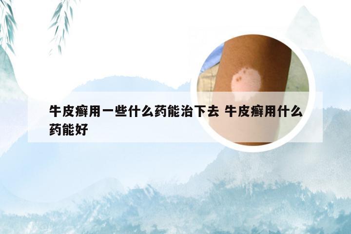 牛皮癣用一些什么药能治下去 牛皮癣用什么药能好