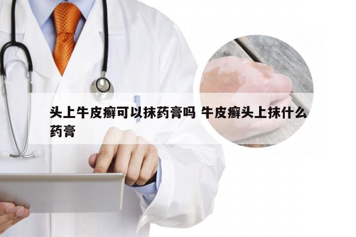 头上牛皮癣可以抹药膏吗 牛皮癣头上抹什么药膏