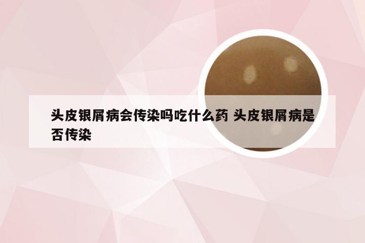 头皮银屑病会传染吗吃什么药 头皮银屑病是否传染