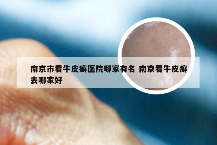 南京市看牛皮癣医院哪家有名 南京看牛皮癣去哪家好
