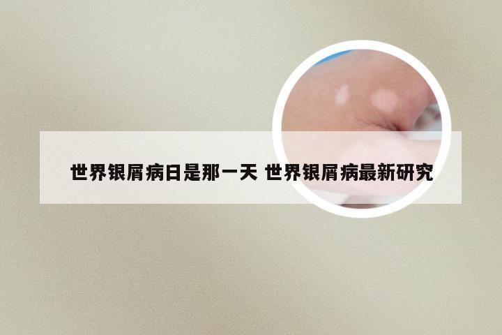 世界银屑病日是那一天 世界银屑病最新研究