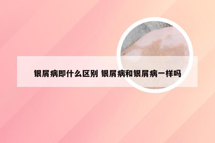 银屑病即什么区别 银屑病和银屑病一样吗