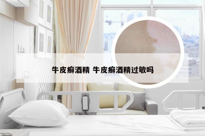 牛皮癣酒精 牛皮癣酒精过敏吗