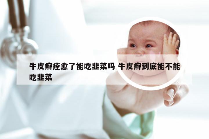 牛皮癣痊愈了能吃韭菜吗 牛皮癣到底能不能吃韭菜