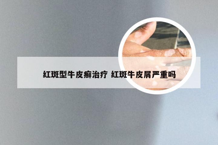 红斑型牛皮癣治疗 红斑牛皮屑严重吗