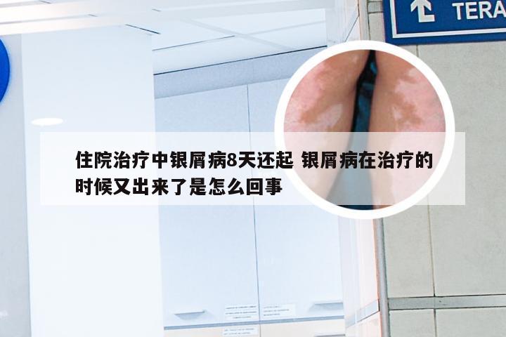 住院治疗中银屑病8天还起 银屑病在治疗的时候又出来了是怎么回事