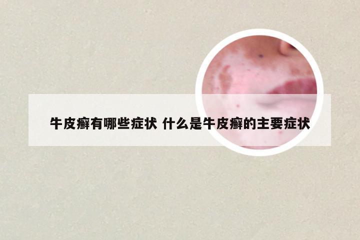 牛皮癣有哪些症状 什么是牛皮癣的主要症状