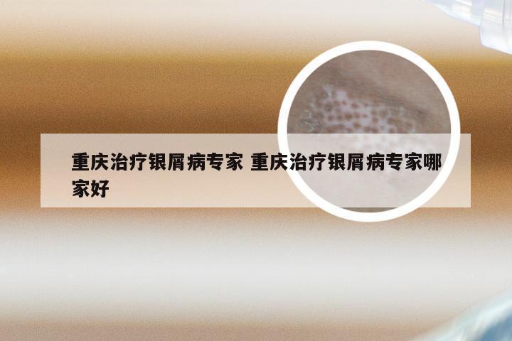 重庆治疗银屑病专家 重庆治疗银屑病专家哪家好