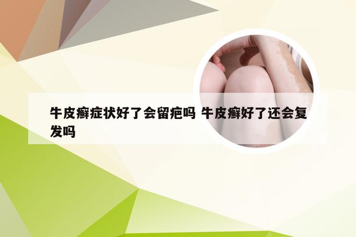 牛皮癣症状好了会留疤吗 牛皮癣好了还会复发吗