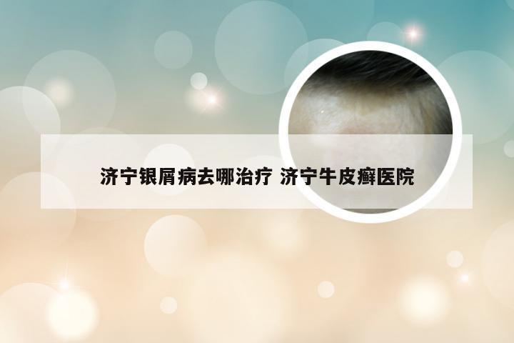 济宁银屑病去哪治疗 济宁牛皮癣医院