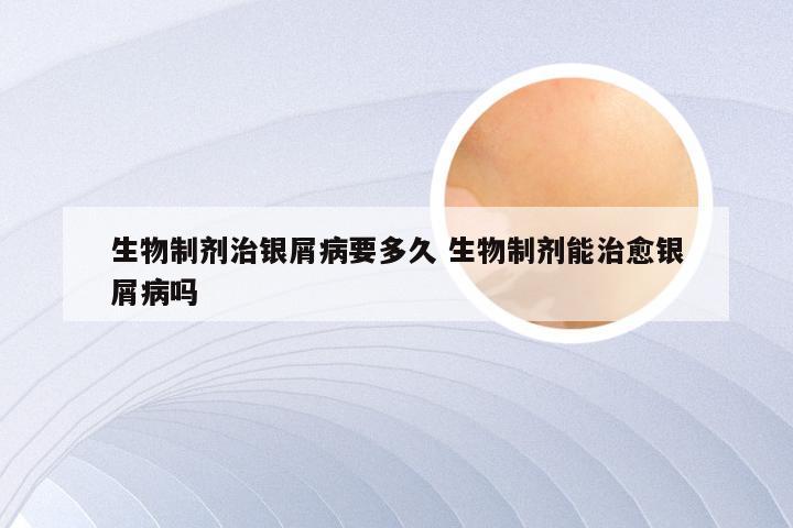 生物制剂治银屑病要多久 生物制剂能治愈银屑病吗