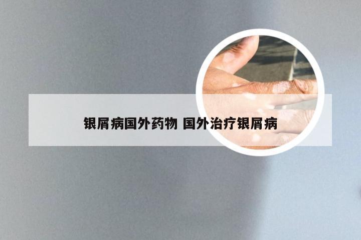银屑病国外药物 国外治疗银屑病
