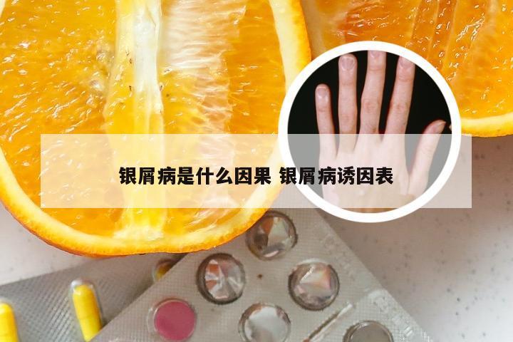 银屑病是什么因果 银屑病诱因表
