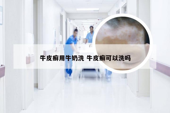 牛皮癣用牛奶洗 牛皮癣可以洗吗