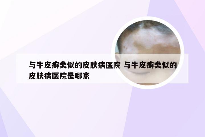与牛皮癣类似的皮肤病医院 与牛皮癣类似的皮肤病医院是哪家