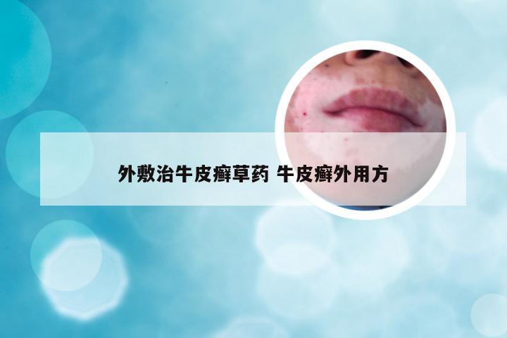 外敷治牛皮癣草药 牛皮癣外用方