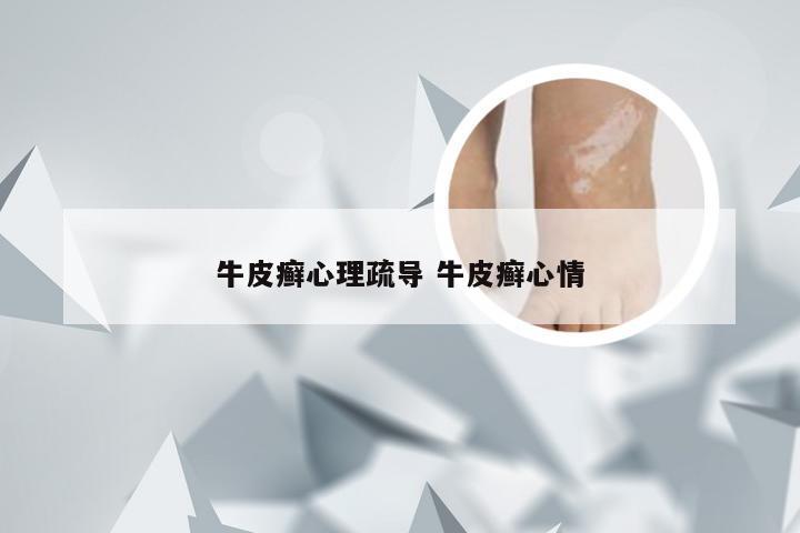 牛皮癣心理疏导 牛皮癣心情