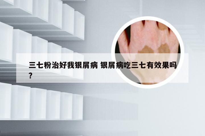 三七粉治好我银屑病 银屑病吃三七有效果吗?
